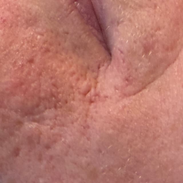 12 month Acne Scar Program at Gingerbeam Spa & Wellness in Salina, KS